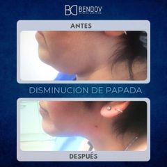 Lipo Vaser Disminución de Papada - Clinica Bendov