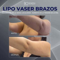 Lipo Vaser Brazos - Clinica Bendov