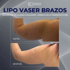 Lipo Vaser Brazos - Clinica Bendov