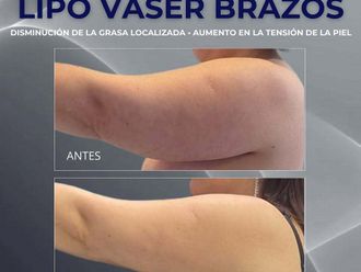 Liposucción antes y después - 872319