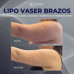 Lipo Vaser Brazos - Clinica Bendov