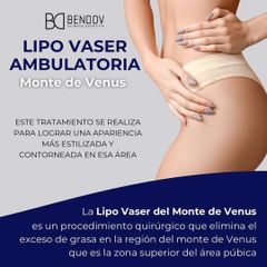 Lipo Vaser Monte de Venus - CLinica Bendov