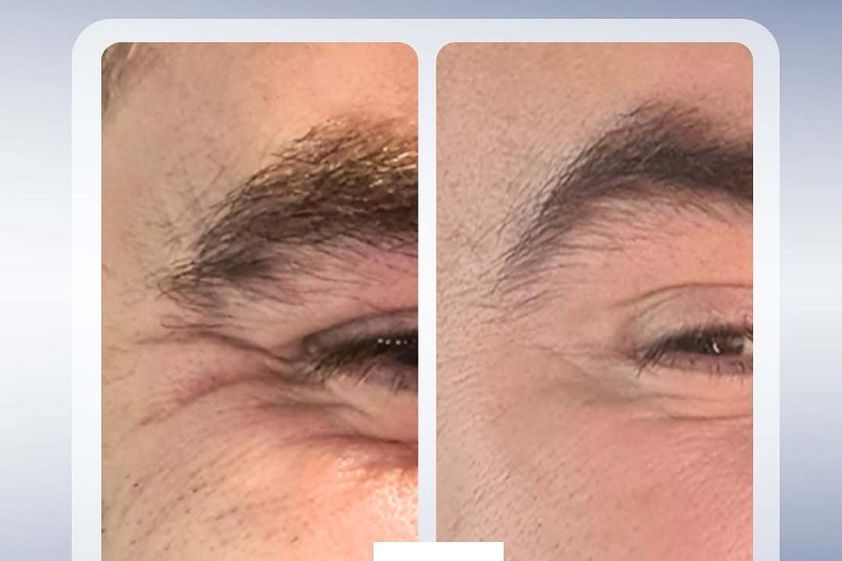 Bótox antes y después - 872321