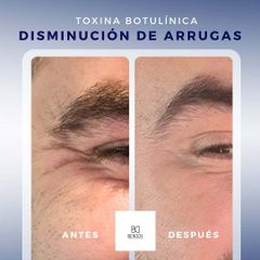 Botox - Clinica Bendov