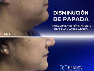 Lipopapada antes y después - 872322