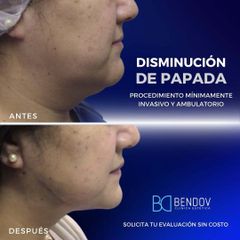 Lipopapada - Clinica Bendov