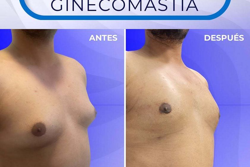 Ginecomastia antes y después - 872324