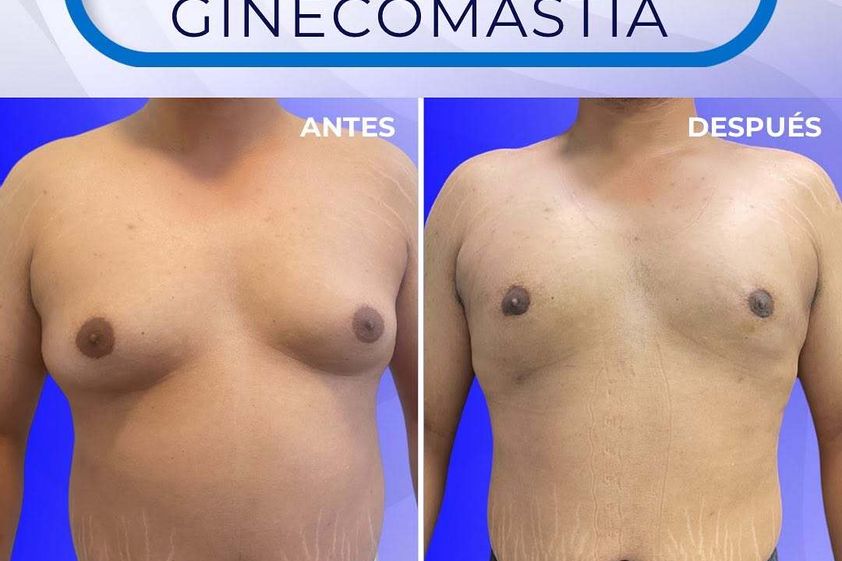 Ginecomastia antes y después - 872325