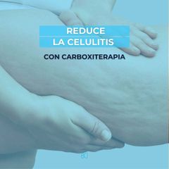 Carboxiterapia - Clinica Bendov