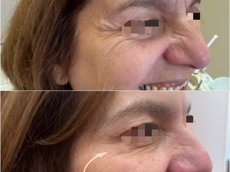 Bótox antes y después - 874340
