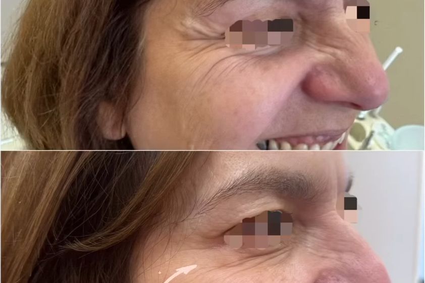 Bótox antes y después - 874340