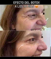 Botox - Dra. María Paz Hidalgo