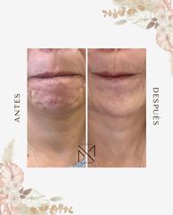 Botox - Dra. María Paz Hidalgo