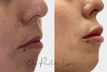 Aumento de labios - Clínica Riodent