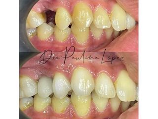 Implantes dentales - Clínica Riodent