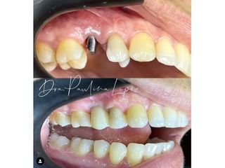 Implantes dentales - Clínica Riodent