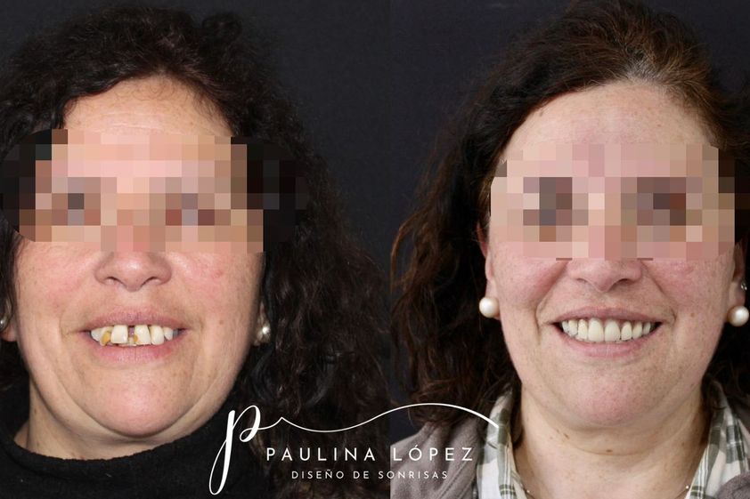 Diseño de Sonrisa antes y después - 847547
