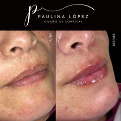 Aumento de labios - Paulina López