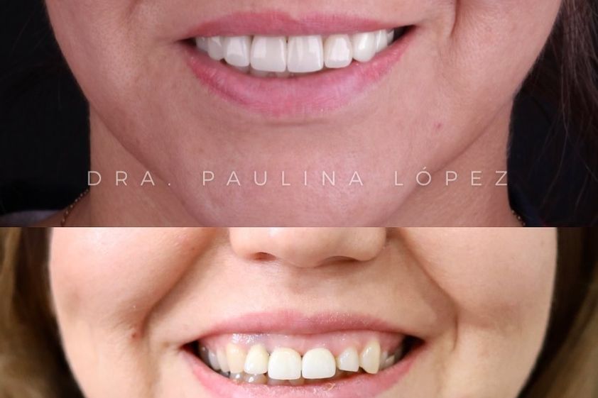 Diseño de Sonrisa antes y después - 848962
