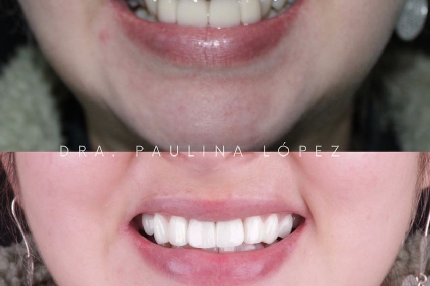Diseño de Sonrisa antes y después - 848963