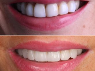 Carillas dentales - 864514