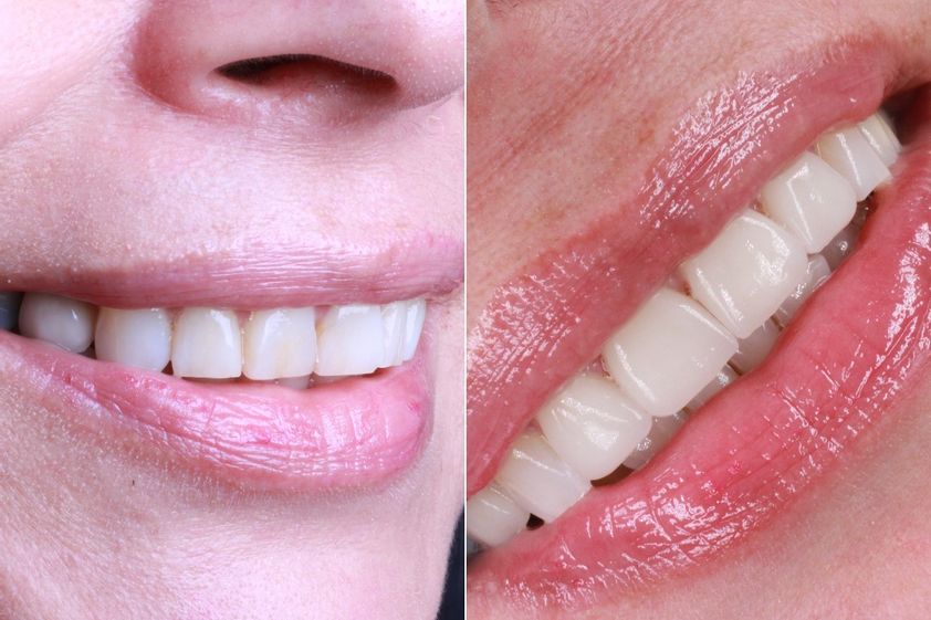 Diseño de Sonrisa antes y después - 864515