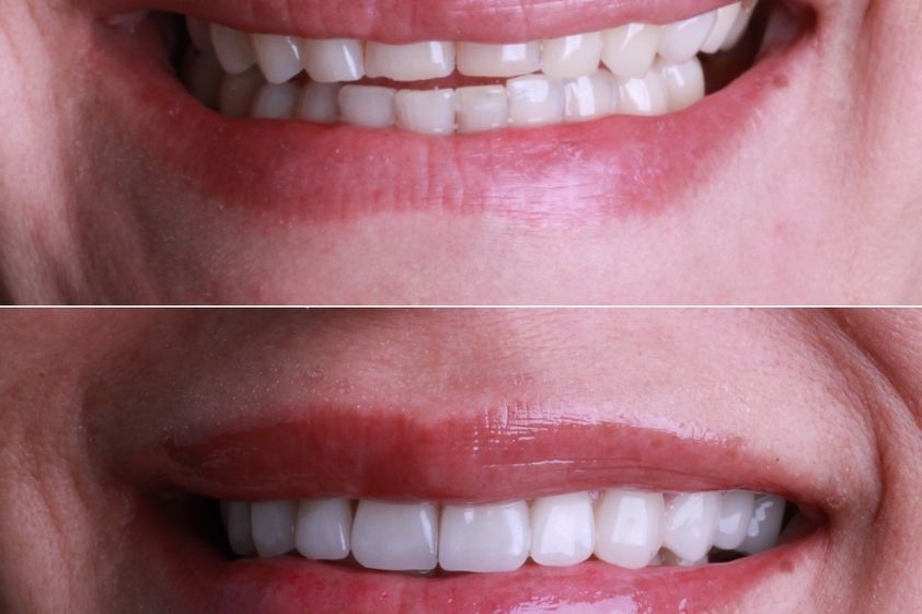 Diseño de Sonrisa antes y después - 864517