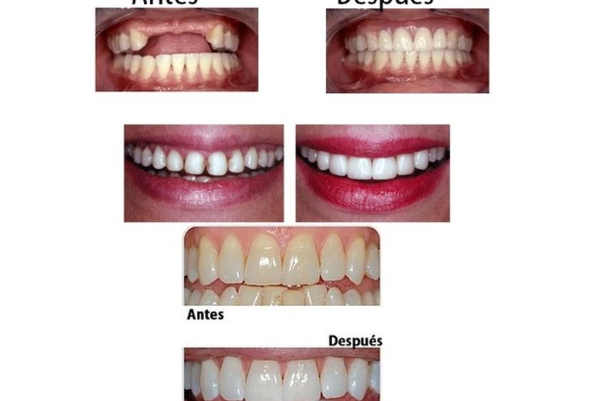 Implantes dentales antes y después - 575357