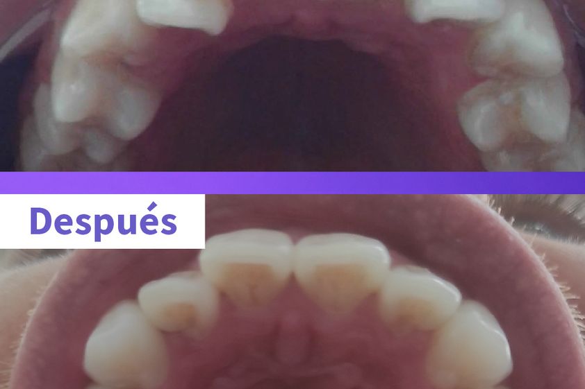 Ortodoncia invisible antes y después - 819255