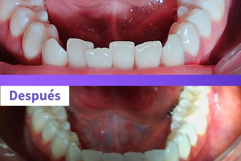Ortodoncia invisible antes y después - 819256