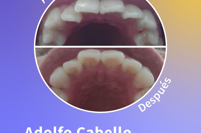 Ortodoncia invisible antes y después - 819258