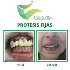 Protesis dentales - Centro Salud Vital