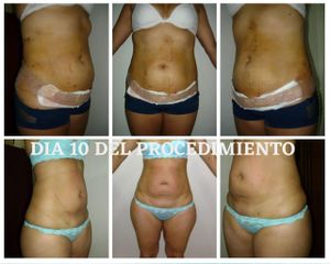 MINI LIPO ESCULTURA- Salud Vital Spa