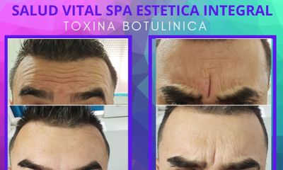 Toxina Botulínica - Salud Vital Spa