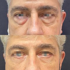 BLEFAROPLASTIA SUPERIOR