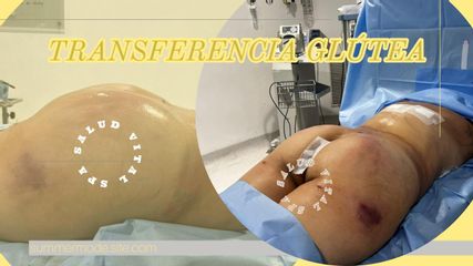 TRANSFERENCIA GLUTEA - Salud Vital Spa