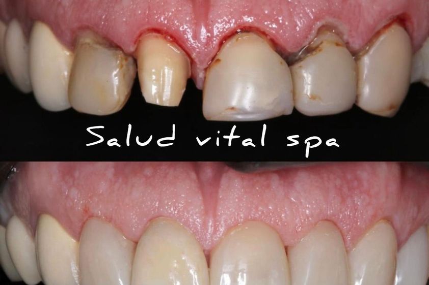 Prótesis dentales antes y después - 852480
