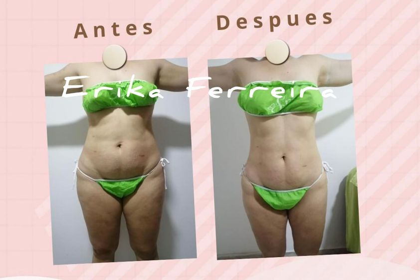 Masaje reductivo antes y después - 852483