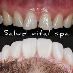 CARILLAS ESTETICAS - Salud Vital Spa