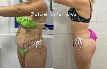 MINI LIPO ESCULTURA- Salud Vital Spa
