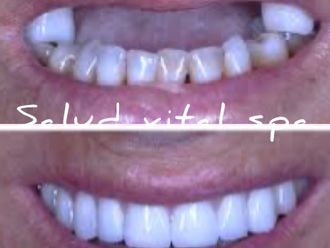 Implantes dentales - 852489