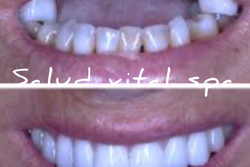 Implantes dentales antes y después - 852489