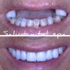 IMPLANTE DENTAL  - Salud Vital Spa