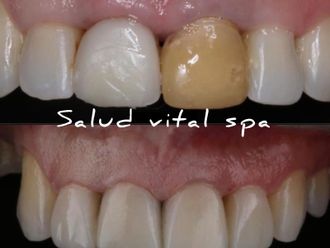 Carillas dentales - 852490