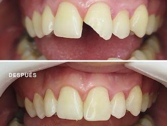 Carillas dentales - 863718