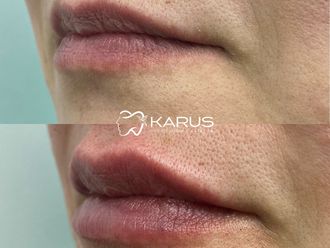 Aumento de labios antes y después - 878286