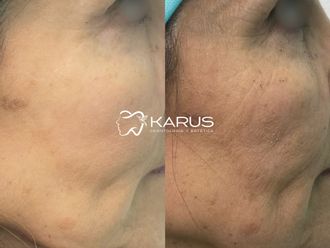 Armonización facial antes y después - 878287