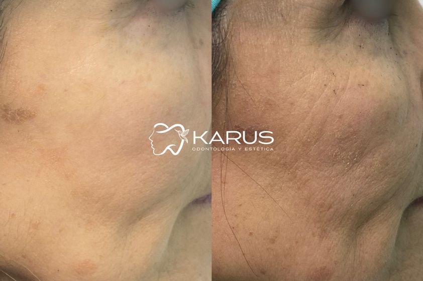 Armonización facial antes y después - 878287