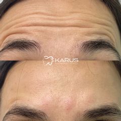 Botox - Clínica Karus