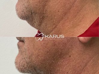 Armonización facial antes y después - 878289